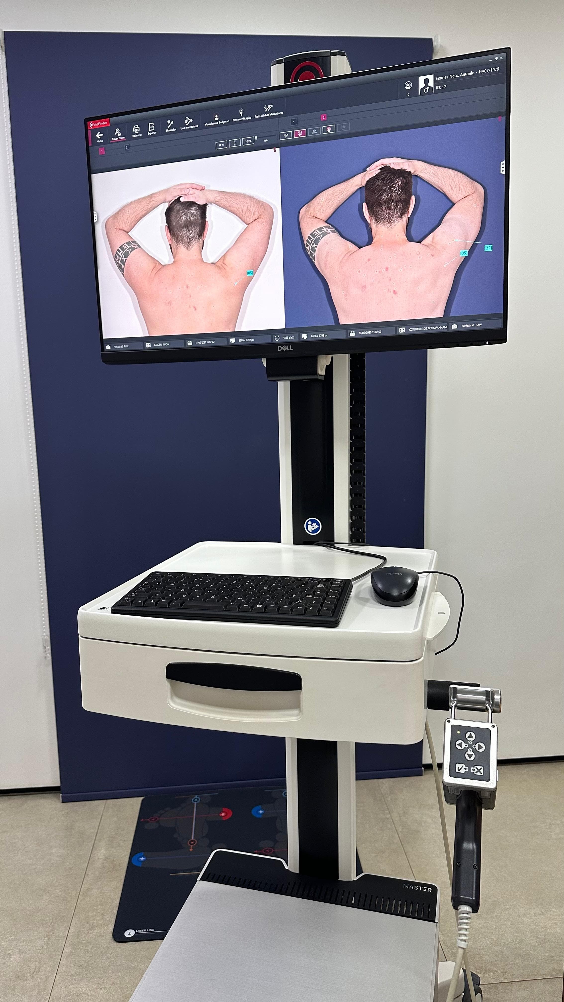 FotoFinder monitor showing digital comparison between skin records